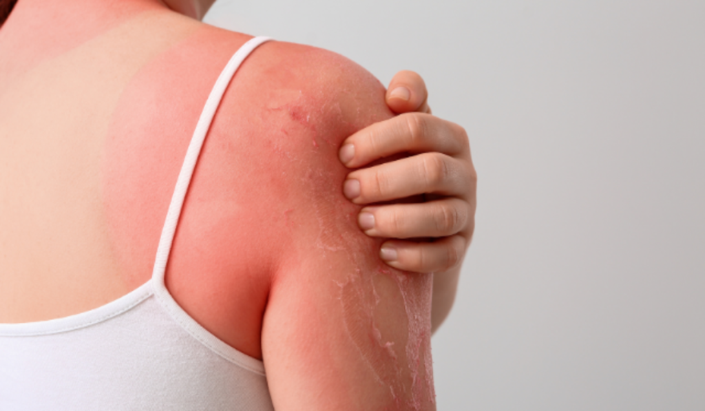 Woman with sunburn peeling