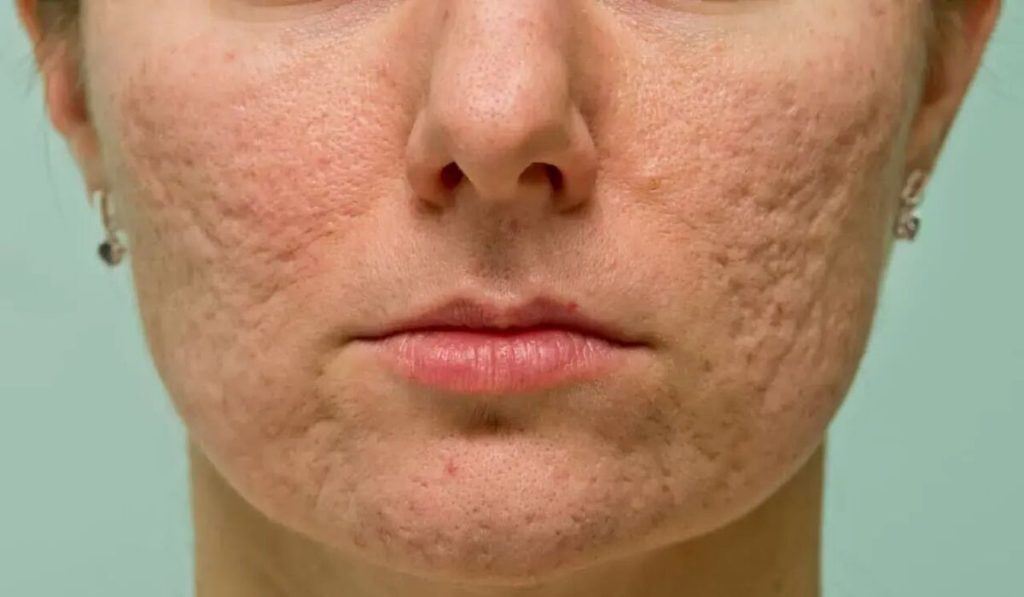 Woman with acne scars needs red light tool