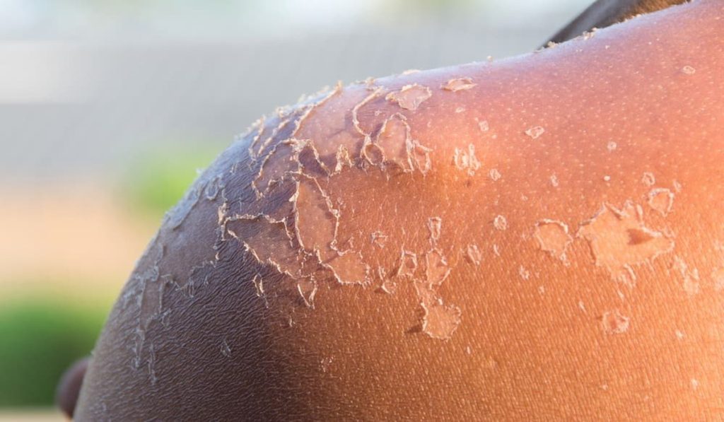 Woman suffering from skin peeling due to sunburn